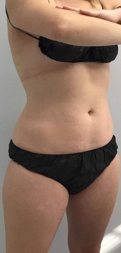 Body Contouring Before & After Patient #16397