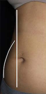 Body Contouring Before & After Patient #16398