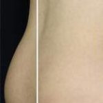 Body Contouring Before & After Patient #16399