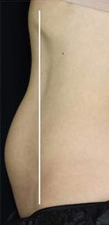 Body Contouring Before & After Patient #16399