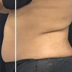 Body Contouring Before & After Patient #16401