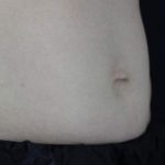 Body Contouring Before & After Patient #16402