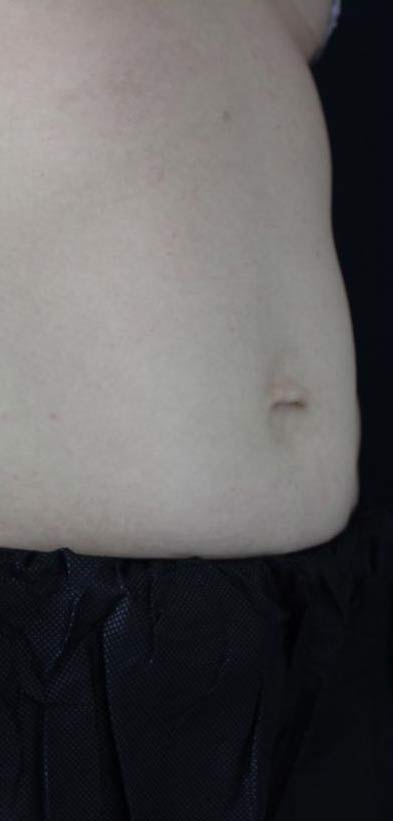 Body Contouring Before & After Patient #16402
