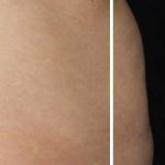 Body Contouring Before & After Patient #16403