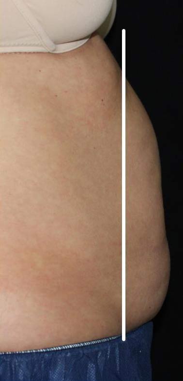 Body Contouring Before & After Patient #16403