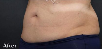 Body Contouring Before & After Patient #16418