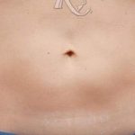 Body Contouring Before & After Patient #16421