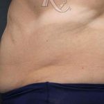 Body Contouring Before & After Patient #16422