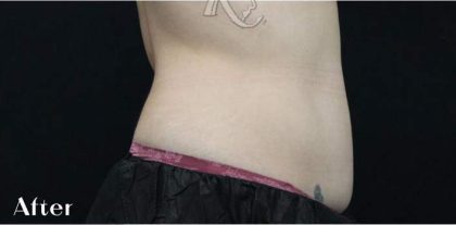 Body Contouring Before & After Patient #16424