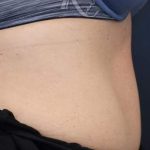 Body Contouring Before & After Patient #16425
