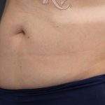 Body Contouring Before & After Patient #16426