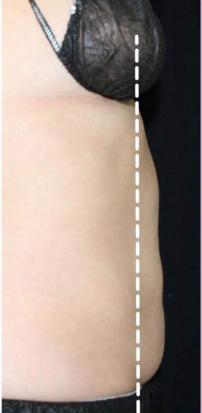 Body Contouring Before & After Patient #16382