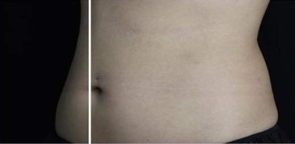 Body Contouring Before & After Patient #16429