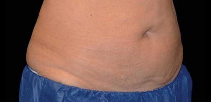 Body Contouring Before & After Patient #16433
