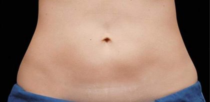 Body Contouring Before & After Patient #16435