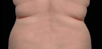 Body Contouring Before & After Patient #16436