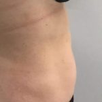 Body Contouring Before & After Patient #16383