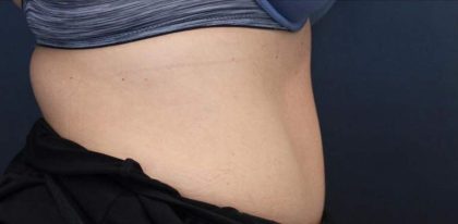 Body Contouring Before & After Patient #16445