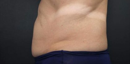 Body Contouring Before & After Patient #16449