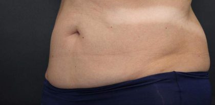 Body Contouring Before & After Patient #16450