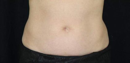 Body Contouring Before & After Patient #16451
