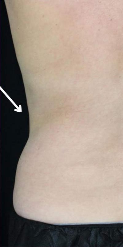 Body Contouring Before & After Patient #16384