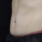 Body Contouring Before & After Patient #16462