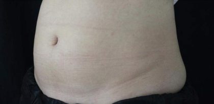 Body Contouring Before & After Patient #16463