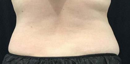 Body Contouring Before & After Patient #16464