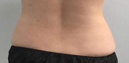 Body Contouring Before & After Patient #16464