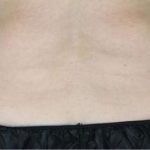 Body Contouring Before & After Patient #16466