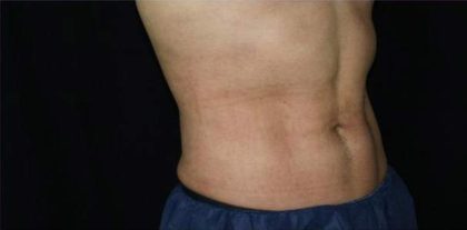 Body Contouring Before & After Patient #16467