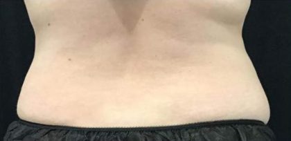 Body Contouring Before & After Patient #16471
