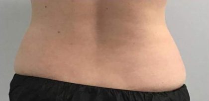 Body Contouring Before & After Patient #16471