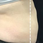 Body Contouring Before & After Patient #16385