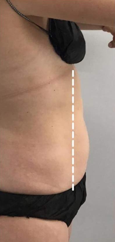 Body Contouring Before & After Patient #16385