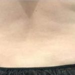 Body Contouring Before & After Patient #16472