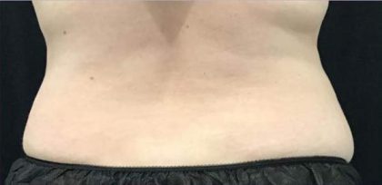 Body Contouring Before & After Patient #16472