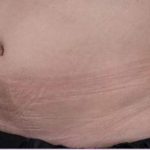 Body Contouring Before & After Patient #16474