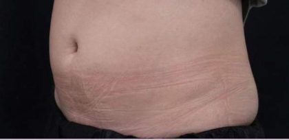 Body Contouring Before & After Patient #16474