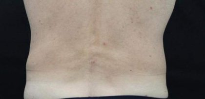 Body Contouring Before & After Patient #16476