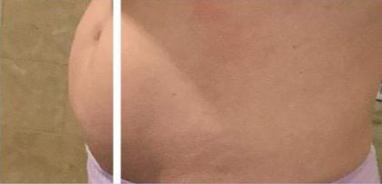 Body Contouring Before & After Patient #16477