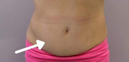 Body Contouring Before & After Patient #16478