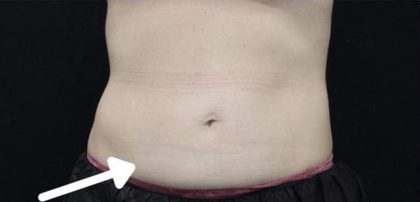 Body Contouring Before & After Patient #16478