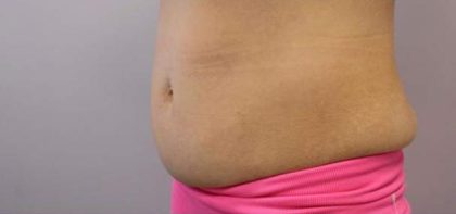 Body Contouring Before & After Patient #16479