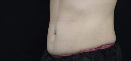 Body Contouring Before & After Patient #16479