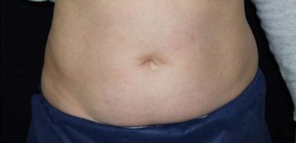 Body Contouring Before & After Patient #16481