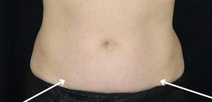 Body Contouring Before & After Patient #16481