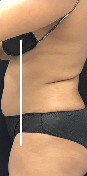 Body Contouring Before & After Patient #16386