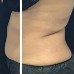 Body Contouring Before & After Patient #16386